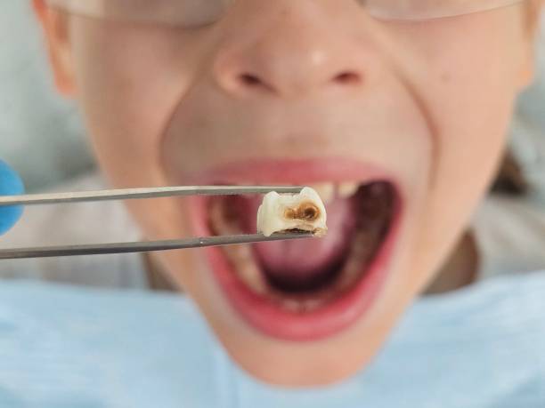 Best Broken Tooth Emergency  in Miramar, FL